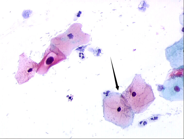 尿沉渣镜检图片如图1所示，箭头所示细胞是()。
