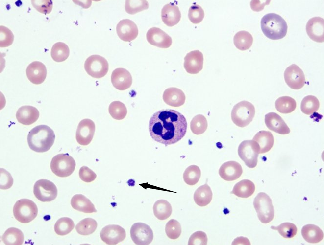 如图2所示，血涂片箭头所指的细胞是()。