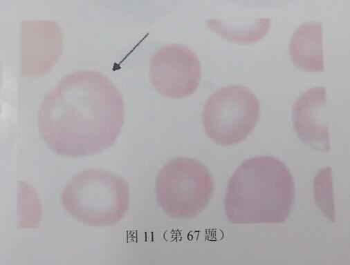 如图11所示，血涂片箭头所示红细胞为()。