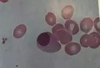 如图所示，图片中的有何细胞为（)。A.淋巴细胞B.单核细胞C.异型淋巴细胞D.晚幼红细胞E.浆细胞请