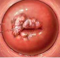 患者，女，35岁，性生活后阴道出血6个月，妇检如图宫颈口见菜花状肿物，最可能诊断为()。