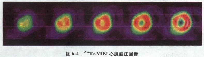 图6－4为99mTc－MIBI心肌灌注断层显像的哪个断层的图像？（) A．短轴断层B．水平长轴C．图