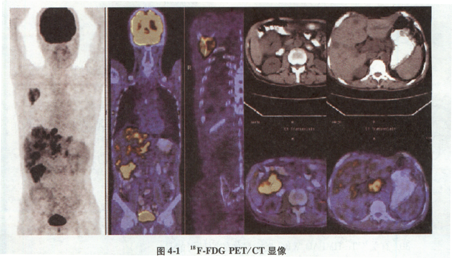 病例1 患者，男，64岁，因上腹部疼痛行CT检查，提示结肠肝曲占位性病变，肝弥漫性病变、腹膜后区占位
