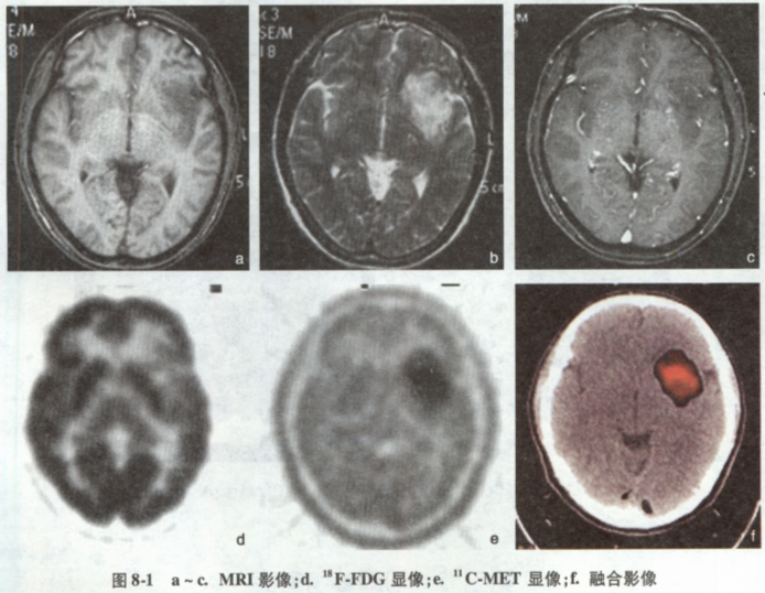 男性，49岁，无诱因突然癫痫发作一次。神经查体：（一)。平扫MRI示左颞呈长T1、长T2信号影，增强
