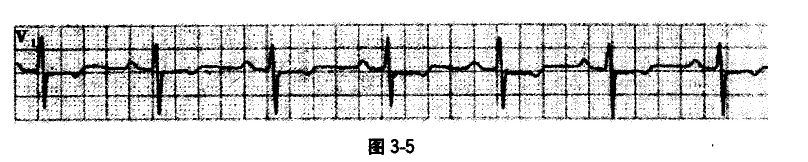 一患者心电图图形如图3－5所示，晟可能的诊断为A.一度房室传导阻滞B.二度I型房室传导阻滞C.二度Ⅱ