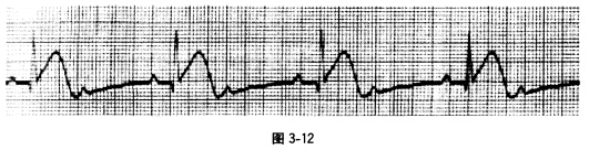 1小时后，患者症状加重，心电图如图3—12所示，诊断为 A．急性下壁心肌梗死，三度房室传导阻滞B．急