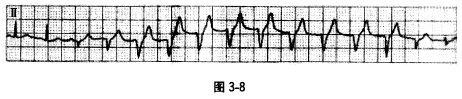 患者男性，48岁。急性心肌梗死溶栓后2小时记录的12导联心电图见图3—8。 第2、3、4、14、15