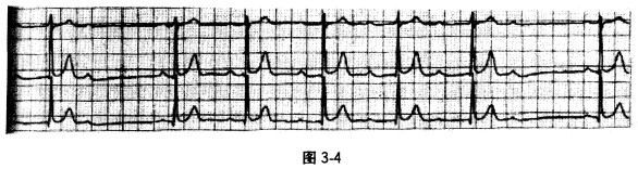 一患者心电图图形如图3—4，最可能的诊断为 A．一度房室传导阻滞B．二度I型房室传导阻滞C．二度Ⅱ型