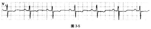 一患者心电图图形如图3—5所示，最可能的诊断为 A．一度房室传导阻滞B．二度I型房室传导阻滞C．二度