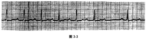 一患者心电图图形如图3—3所示，最可能的诊断为 A．窦房阻滞B．二度I型房室传导阻滞C．二度Ⅱ型房室