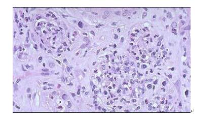该病理图片示肾间质纤维化伴炎细胞浸润，可考虑 （)A.急性间质性肾炎B.慢性间质性肾炎C.急性肾小该