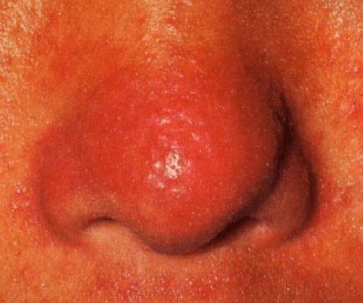 鼻端生红色粉刺(酒齄鼻)，是什么原因导致的？