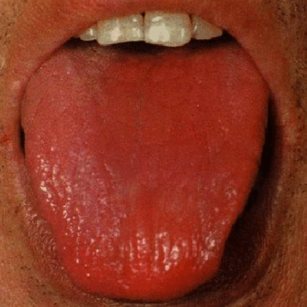 肾阴虚舌象图片