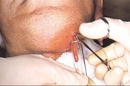 口腔颌面部感染脓肿形成后行切开引流术的要点，下列哪一项除外  （)A、切口部位应在脓肿低位，尽口腔颌