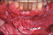 关于牙龈癌（如图)的叙述，哪项是错误的  （)A、多为鳞状细胞癌B、男性多于女性，以溃疡型多见C、早