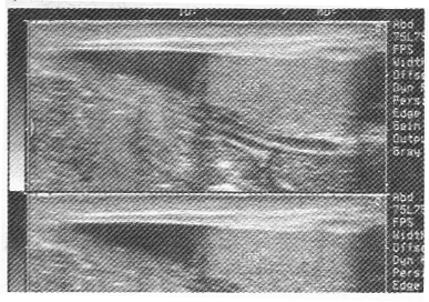 男，阴囊肿大，超声检查于右侧腹股沟见一混杂回声团块，探头推压可回纳腹腔。如图所示，考虑为A、隐睾B男