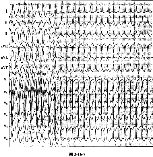 患者男性，39岁，反复发作心慌数年，心慌时心电图记录如图3－16－7所示，心电图显示宽QRS波群的R