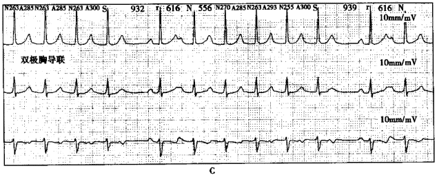 男性，33岁，心悸1周就诊。动态心电图检查如下图A、B、C所示。   图A应诊断为 A、窦性心动过速