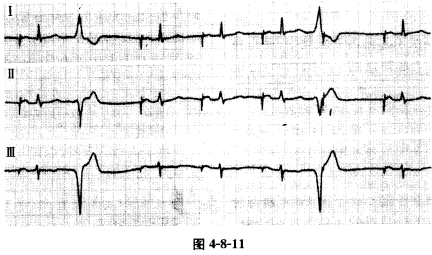 AAI起搏器患者，有心悸症状，心电图如图4－8－11所示，正确的诊断为A、感知不良B、感知过度C、起