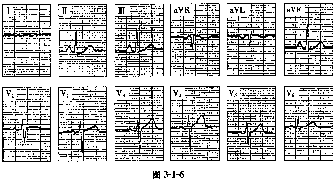 患者，男性，65岁，慢性咳嗽史30余年。心电图如图3－1－6所示，提示A、风湿性心脏病，二尖瓣狭窄B