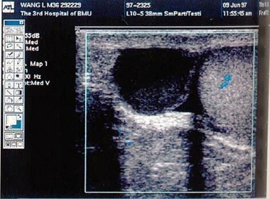 患者，男，23岁，发现睾丸内无痛性肿块1月余。透光试验阳性。结合超声图像，最可能的诊断是   （)A