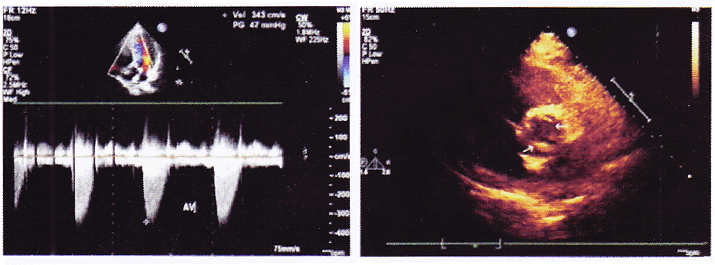 患者，男性，16岁，体检发现心脏杂音，要求行超声心动图检查，如图所示，最准确的诊断为A、主动脉瓣轻度