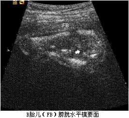 孕妇，30岁，孕2产0孕22周。超声（孕12周）：宫内妊娠，单绒毛膜囊双羊膜囊双活胎，A胎儿NT 0