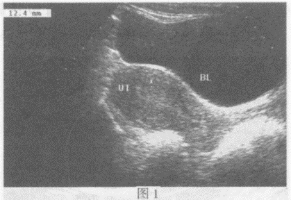 图1临床资料：女性，32岁，常规体检。超声综合描述：经腹扫查子宫形态、大小正常，肌层回声均匀，子宫内