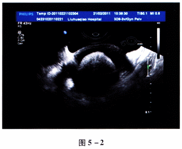 关于卵巢囊性畸胎瘤声像图（图5－2）的描述，不正确的是　　A、形态呈圆形、椭圆形B、囊壁光滑C、囊内