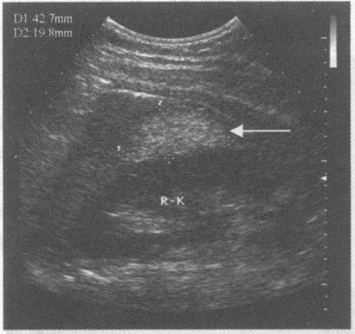 临床资料：男，38岁，常规体检。超声综合描述：右肾脂肪囊可见4．2cm×2．0cm中强回声区（箭头所