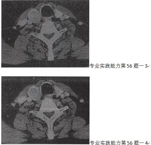 男，43岁，右颈部扪及一包块，CT如图所示，最可能的诊断是A.甲状腺腺瘤 B.甲状腺腺癌C.结节性甲