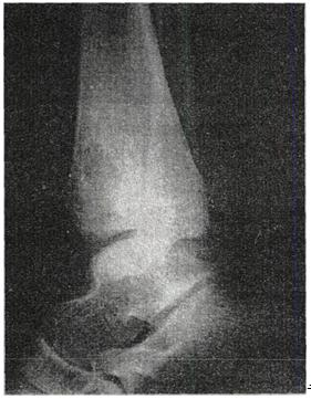 男性，13岁，右踝3个月前扭伤，进20天来疼痛，局部轻度肿胀。X线片见图。应首先考虑的诊断是A.骨囊