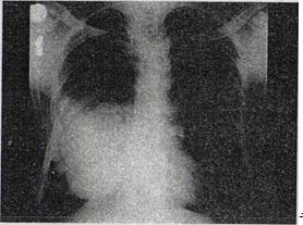 患者50岁，男，右侧胸痛、咳嗽、咯血3个月，结合胸片和CT检查，最可能的诊断是A.纵隔肿瘤B.肺患者