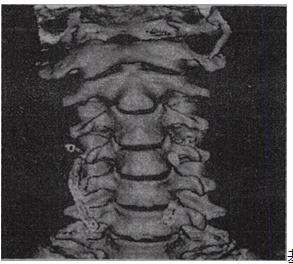 此颈椎CT后处理图像为基础知识第88题此颈椎CT后处理图像为  基础知识第88题A.冠状MIP(最大