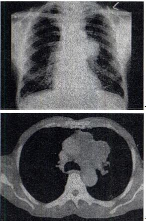 患者60岁，男，有长期吸烟史，左声带麻痹、声音嘶哑2个月，结合胸片和CT，最可能的诊断是A.肺癌 B