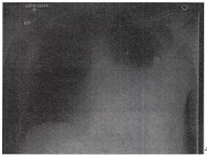 患者，男，48岁，呼吸困难、胸痛，结合CT图像，最可能的诊断是A.支气管胸膜瘘B.肺结核 C.吸入性