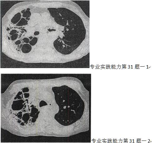 男，31岁，反复咳嗽，咯血10年余，结合影像学检查，最可能的诊断是 A.肺囊肿 B.间质性肺炎C.肺