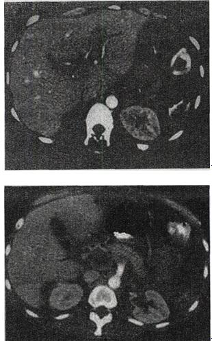 男，46岁，脾脏术后3天，右上腹痛，CT扫描如图，最可能的诊断是A.肝脏正常、脾脏术后改变B.肝男，