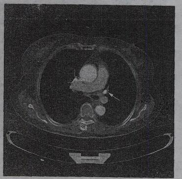 图中箭头所指的是A.左肺下动脉B.右肺上动脉C.左肺上静脉D.左肺上动图中箭头所指的是A.左肺下动脉