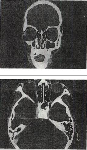 女，46岁，自述左眼视物不清约3个月，CT扫描如图所示，正确的描述或诊断是A.双侧眼球未见病变B.左