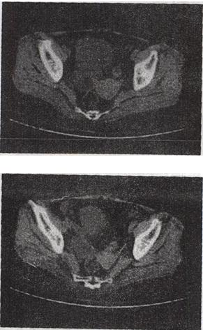 女，27岁，体检时B超发现右侧附件区囊性占位性病变，CT检查如图，下列说法错误的是A.病灶来源于右侧