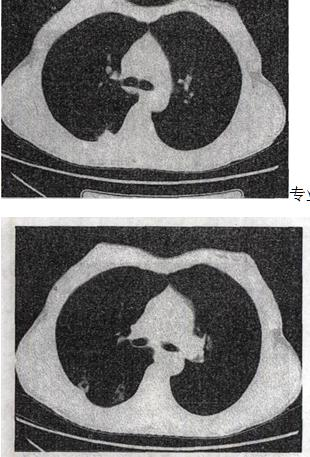 女，40岁，间断咯血l周，低热，行胸部CT扫描如图，最可能的诊断是A.肺结核 B.肺部感染C.支气管