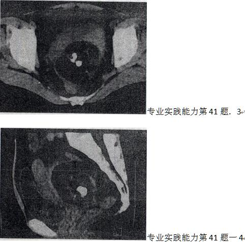 女，52岁，下腹部胀痛，8超提示盆腔占位，CT扫描如图所示，盆腔内见囊实性肿块，其内CT值不均，从一
