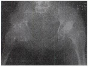 男，60岁，因双髋关节反复疼痛2年余，无明显外伤史，X线摄片如图，最可能的诊断是A.双髋关节退行性骨