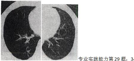 患者女，23岁，咳嗽咳痰反复发作，根据CT图像，最可能的诊断是A.支气管扩张并感染 B.多发肺患者女