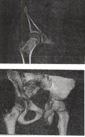 男，13岁，右髋部疼痛不适，无红肿，结合所提供的图像，最可能的诊断是A.非骨化性纤维瘤B.骨男，13