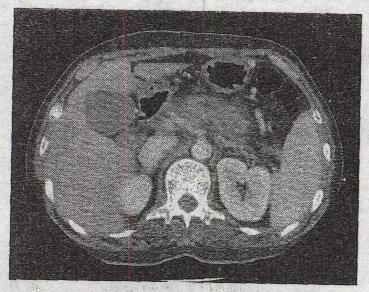 男，56岁。上腹不适3个月，CT检查如图。CT诊断最可能为A.胰腺癌B.胰腺囊肿C.慢性男，56岁。