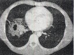 患者男，42岁，高热，寒战，咳嗽，胸痛1周左右，CT检查如图，最可能的诊断是A.肺结核 B.肺癌C.