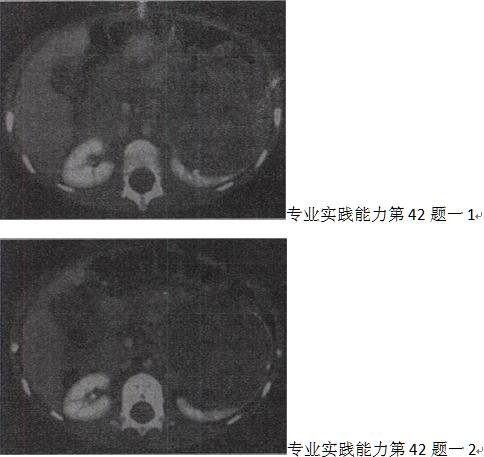 女，54岁，发现腹部包块，根据所示图像，最可能的诊断是A.左侧肾癌 B.左侧单纯性肾囊肿C.左侧肾囊