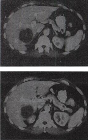 女，58岁，肝区疼痛半个月，发热，白细胞升高，CT检查如图，最可能的诊断是A.原发性肝癌B.肝女，5